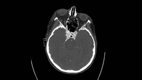 Carotid cavernous fistula