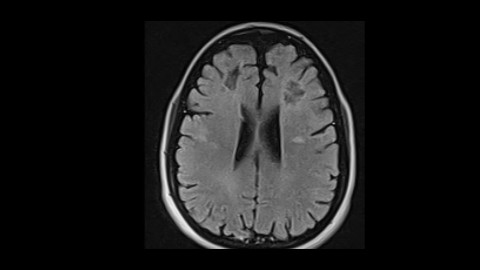 Multiple sclerosis with FLAIR hypointense lesions