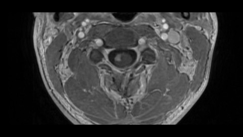 Acute myelitis, first onset Multiple Sclerosis