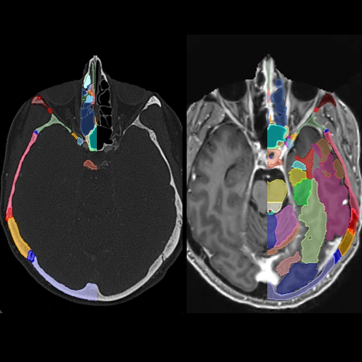 Comprehensive Head CT + MRI Anatomy: Brain, Skullbase and Sinonasal Cavity