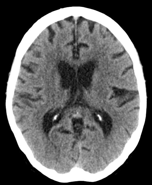 Cortical contusions and subarachnoid hemorrhage (EDNeurorad Case 1)