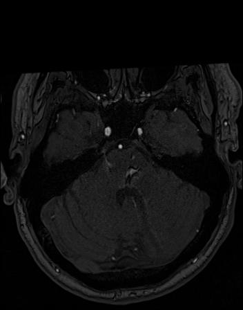 Intracranial Aneurysm - From Lausanne MRA Aneurysm Cohort (sub-485)