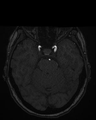 Multiple Intracranial Aneurysms - From Lausanne MRA Aneurysm Cohort (sub-486)