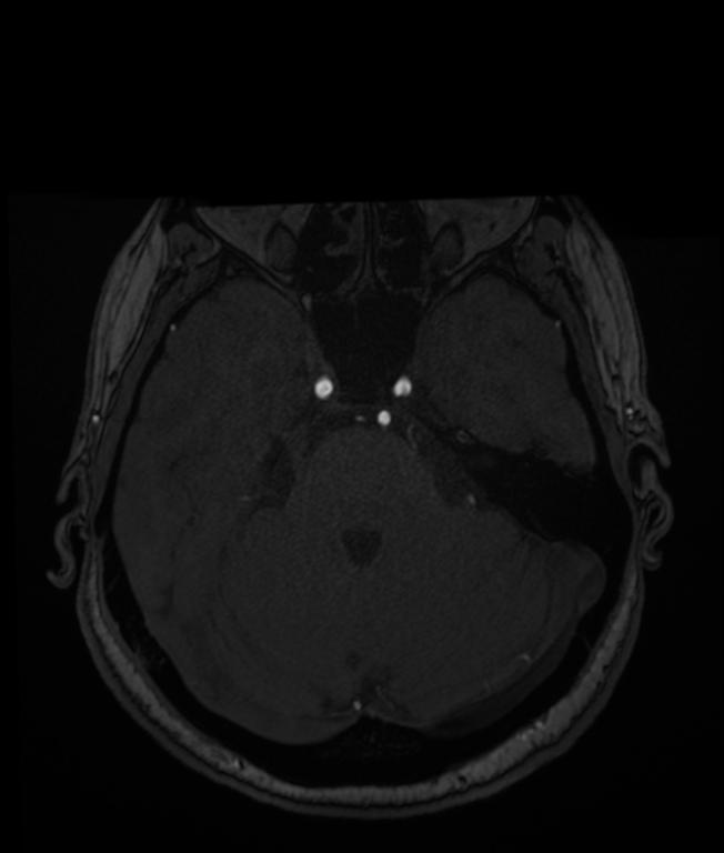 Multiple Intracranial Aneurysms - From Lausanne MRA Aneurysm Cohort (sub-487)
