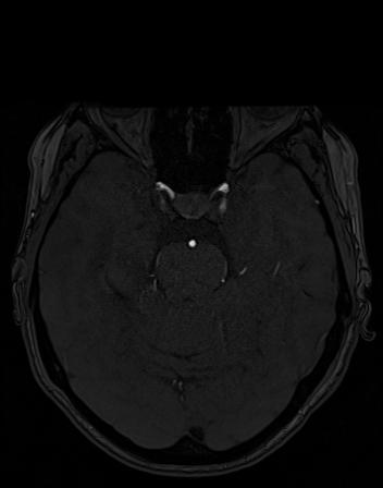 Intracranial Aneurysm - From Lausanne MRA Aneurysm Cohort (sub-488)