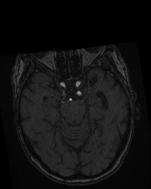 Intracranial Aneurysm - From Lausanne MRA Aneurysm Cohort (sub-489)