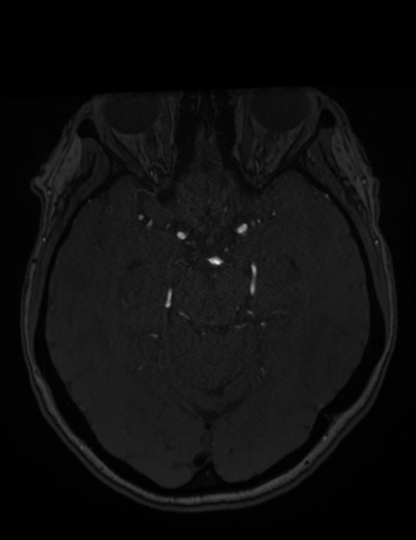 Intracranial Aneurysm - From Lausanne MRA Aneurysm Cohort (sub-490)