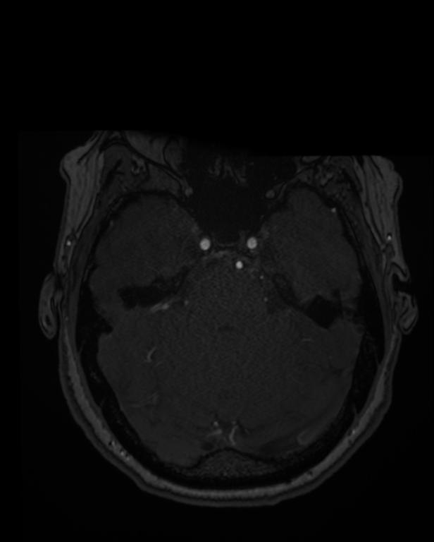 Intracranial Aneurysm - From Lausanne MRA Aneurysm Cohort (sub-491)