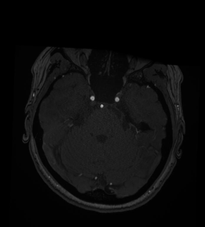 Intracranial Aneurysm - From Lausanne MRA Aneurysm Cohort (sub-492)