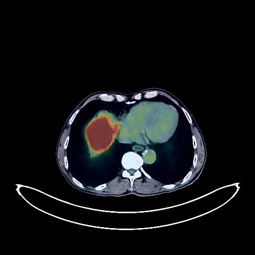 Liver Cancer PET/CT (case 984005-000020 from PETWB-REP)