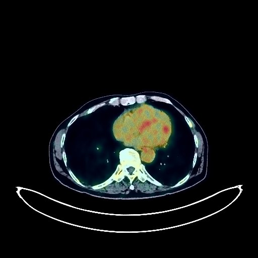 Liver Cancer PET/CT (case 984005-000021 from PETWB-REP)