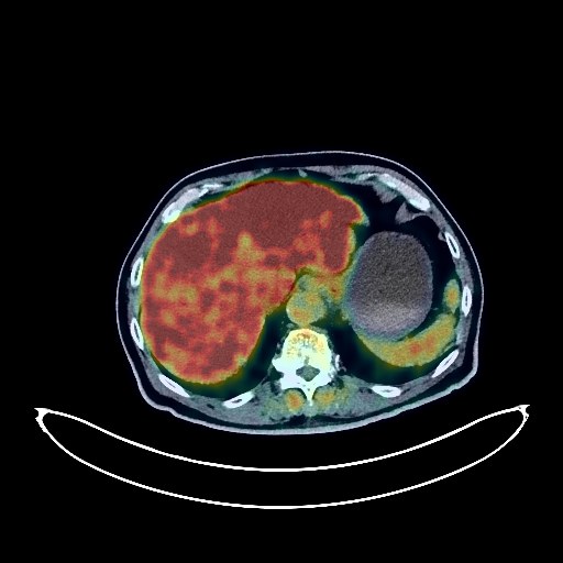 Liver Cancer PET/CT (case 984005-000023 from PETWB-REP)