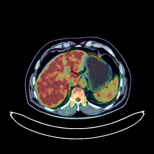 Liver Cancer PET/CT (case 984005-000024 from PETWB-REP)