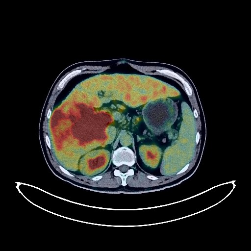 Liver Cancer PET/CT (case 984005-000025 from PETWB-REP)