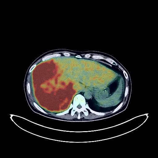 Liver Cancer PET/CT (case 984005-000026 from PETWB-REP)