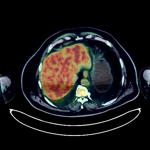 Liver Cancer PET/CT (case 984005-000027 from PETWB-REP)