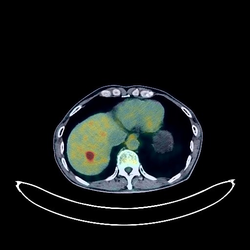 Liver Cancer PET/CT (case 984005-000028 from PETWB-REP)