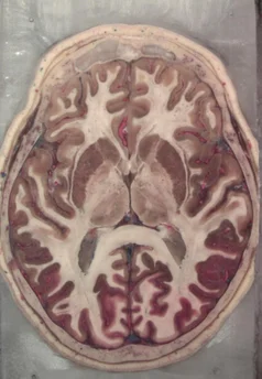 Head Anatomy Module from the Visible Human Project (Half Resolution)